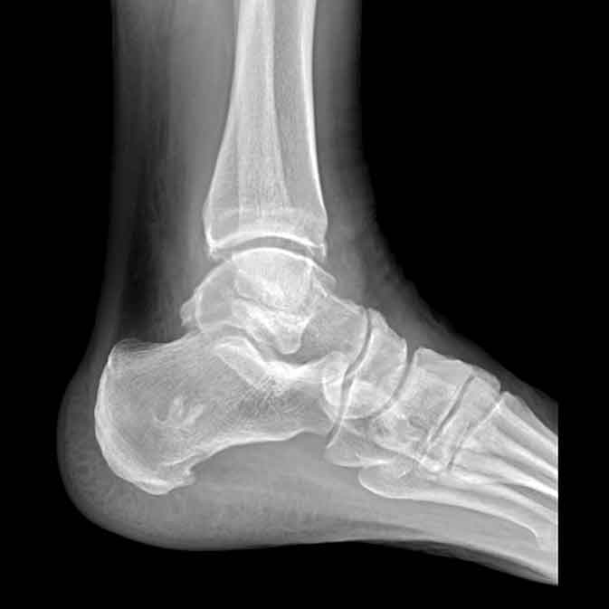 Ankle pain
